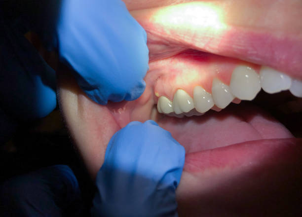 Best Knocked-Out Tooth (Avulsed Tooth) Treatment in City View, SC